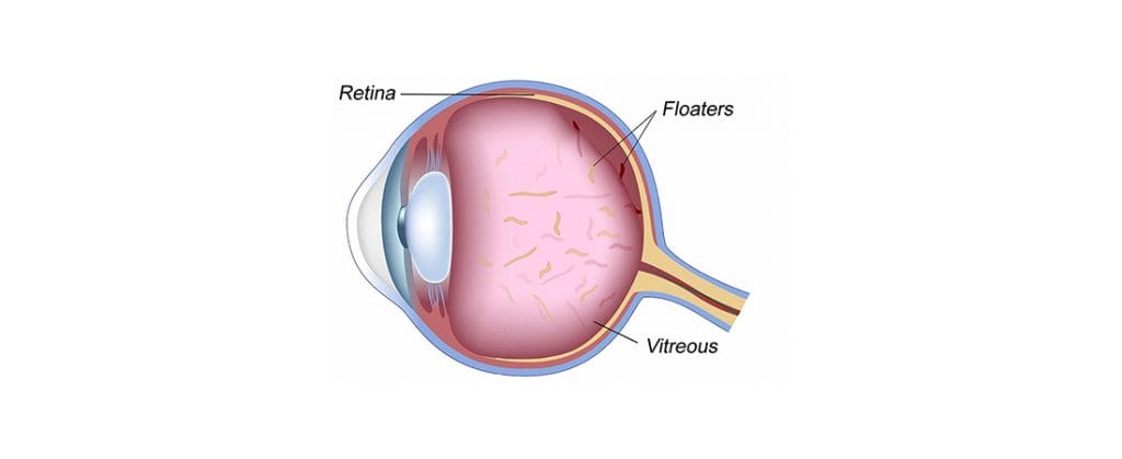 Blogginlägg om Eye floaters